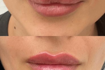 DISSOLVING FILLERS