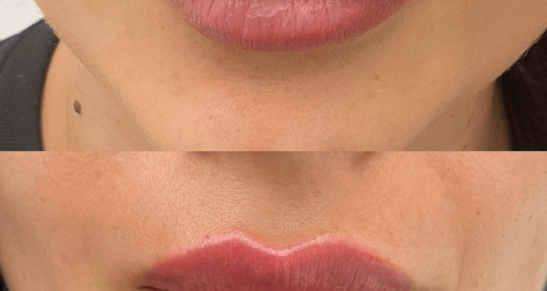 DISSOLVING FILLERS