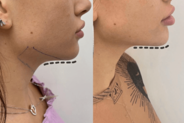 DOUBLE CHIN, CHEEKS, CONTOUR FAT, REMOVAL