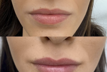 FILLERS